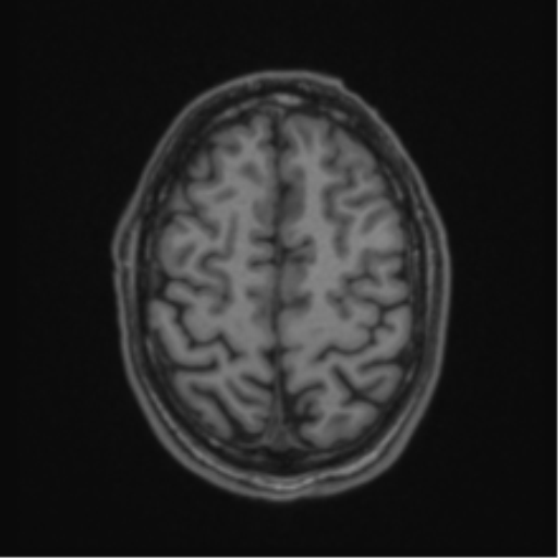 Anaplastic oligodendroglioma with skull fracture (Radiopaedia 74831-85845 Axial T1 53).png
