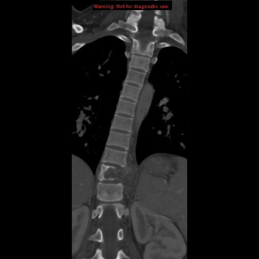 File:Aneurysmal bone cyst (Radiopaedia 9419-10102 Coronal bone window 9).jpg