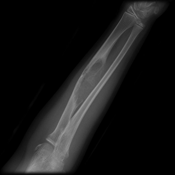 File:Aneurysmal bone cyst - radius (Radiopaedia 5866-7440 Frontal 1).jpg