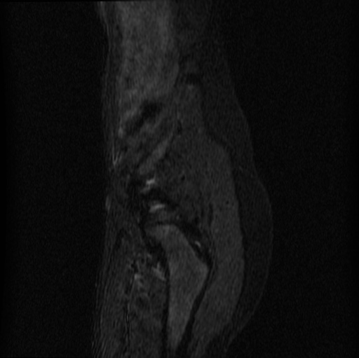 File:Aneurysmal bone cyst - sacrum (Radiopaedia 65190-74196 Sagittal STIR 31).jpg