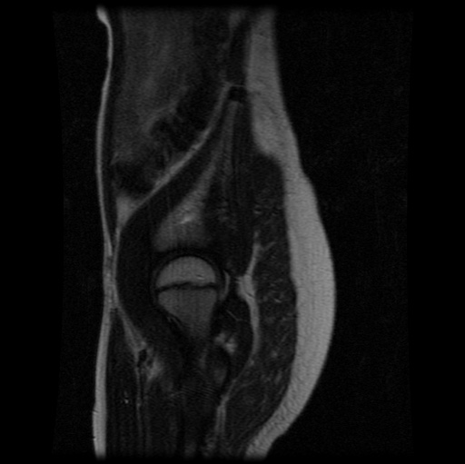 File:Aneurysmal bone cyst - sacrum (Radiopaedia 65190-74196 Sagittal T2 29).jpg