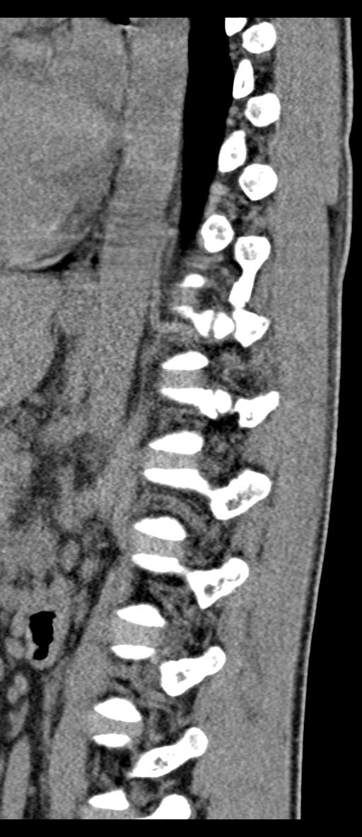 Aneurysmal bone cyst T11 (Radiopaedia 29294-29721 E 26).jpg