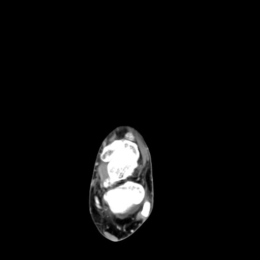 File:Aneurysmal bone cyst of the calcaneus (Radiopaedia 60669-68421 A 22).jpg
