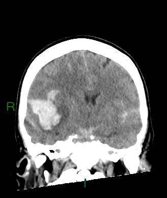 File:Aneurysmal subarachnoid hemorrhage with intra-axial extension (Radiopaedia 84371-99699 Coronal non-contrast 38).jpg