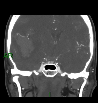File:Aneurysmal subarachnoid hemorrhage with intra-axial extension (Radiopaedia 84371-99732 C 55).jpg