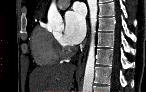 Anomalous left coronary artery from the pulmonary artery (ALCAPA) (Radiopaedia 70148-80181 C 116).jpg