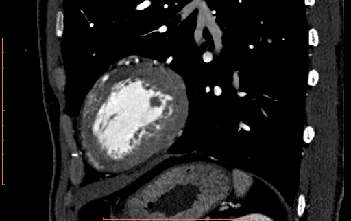 File:Anomalous left coronary artery from the pulmonary artery (ALCAPA) (Radiopaedia 70148-80181 C 208).jpg