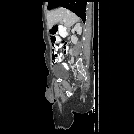 File:Anorectal carcinoma (Radiopaedia 44413-48064 C 37).jpg