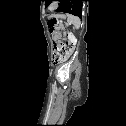 Anorectal carcinoma (Radiopaedia 44413-48064 C 89).jpg