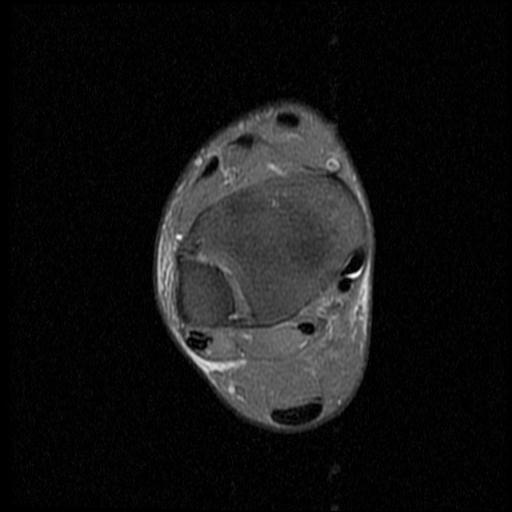 File:Anterior calcaneal process fracture (Radiopaedia 71377-81705 Axial PD fat sat 4).jpg