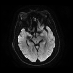 Anterior cerebral artery infarction (Radiopaedia 46794-51323 Axial DWI 13).jpg