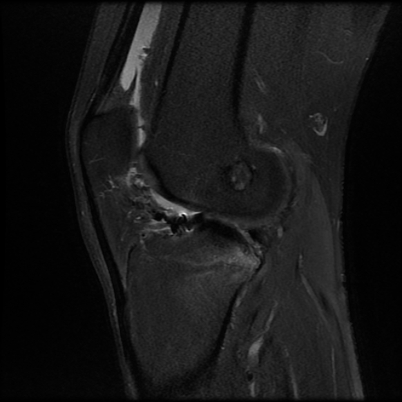File:Anterior cruciate ligament graft tear and bucket-handle tear of medial meniscus (Radiopaedia 75867-87254 Sagittal PD fat sat 17).jpg