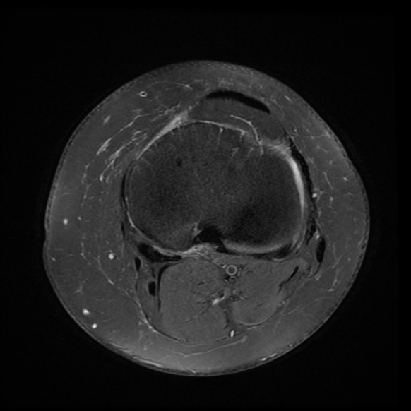 File:Anterior cruciate ligament tear, Wrisberg rip and bucket-handle tear of medial meniscus (Radiopaedia 75872-87266 Axial PD fat sat 8).jpg