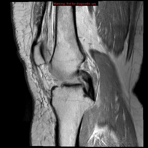 File:Anterior cruciate ligament tear (Radiopaedia 12329-12612 Sagittal T2 fat sat 12).jpg