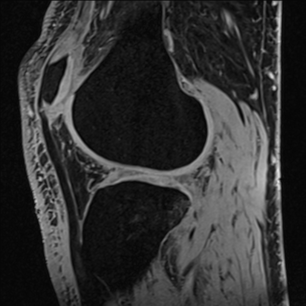 Anterior cruciate ligament tear - ramp lesion (Radiopaedia 71883-82322 Sagittal T1 vibe 48).jpg