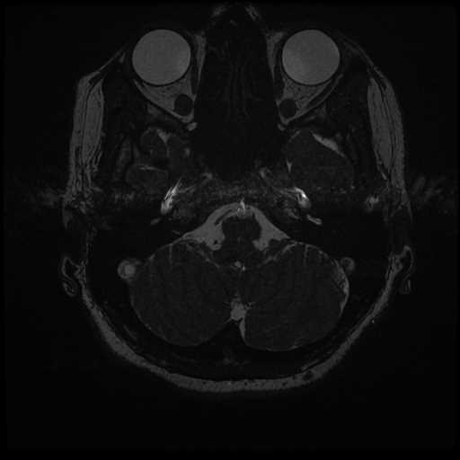 Anterior inferior cerebellar artery vascular loop - type II (Radiopaedia 70991-81209 Axial 3D FIESTA 57).jpg