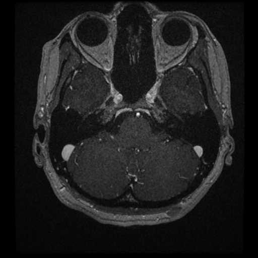 Anterior inferior cerebellar artery vascular loop - type II (Radiopaedia 70991-81209 Axial T1 C+ 55).jpg