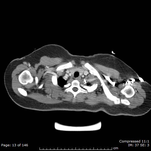 Anterior mediastinal B cell Lymphoma (Radiopaedia 50677-56114 A 7).jpg