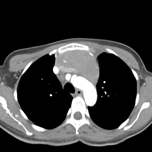 Anterior mediastinal lymphoma (Radiopaedia 29556-30061 C 16).jpg