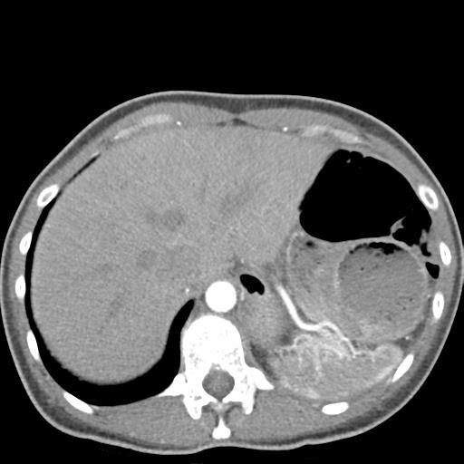 File:Anterior mediastinal lymphoma (Radiopaedia 29556-30061 C 51).jpg
