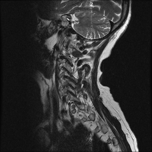 File:Anterior spinal artery syndrome (Radiopaedia 46335-50750 A 10).png