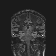 Anterior temporal encephalocele (Radiopaedia 82624-96808 Coronal FLAIR 31).jpg