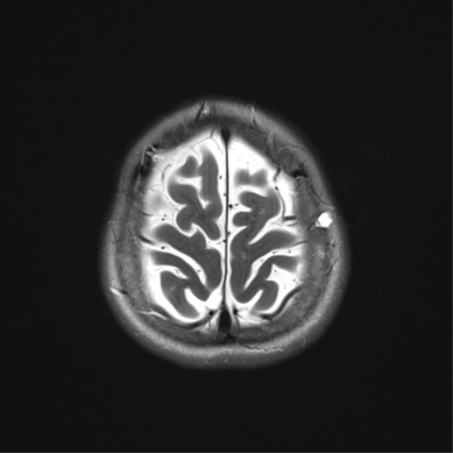 File:Anterior temporal lobe perivascular space (Radiopaedia 40946-43650 Axial T2 34).png