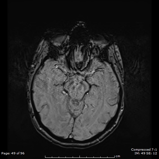 Anterior temporal lobe perivascular space (Radiopaedia 88283-104914 Axial SWI 18).jpg
