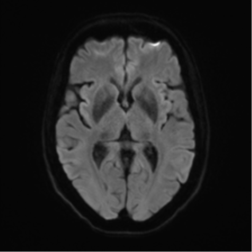Anterior temporal pole cysts (Radiopaedia 46629-51102 Axial DWI 41).png