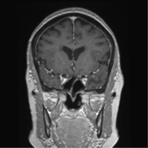 Anterior temporal pole cysts (Radiopaedia 46629-51102 Coronal T1 C+ 113).png