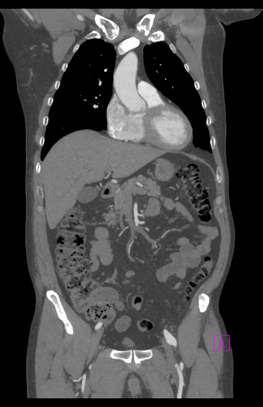 Aortectomy and axillary-bifemoral bypass (Radiopaedia 28303-28545 C 36).jpg