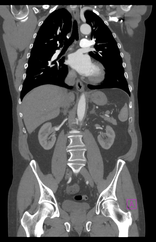 Aortectomy and axillary-bifemoral bypass (Radiopaedia 28303-28545 C 52).jpg
