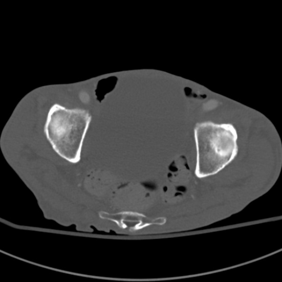 Aortic aneurysm with spinal destruction (Radiopaedia 42301-45410 Axial bone window 98).jpg