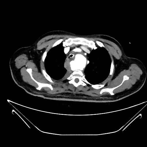 File:Aortic arch aneurysm (Radiopaedia 84109-99365 C 41).jpg