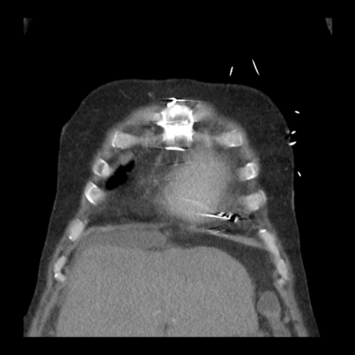 Aortic arch graft infection (FDG PET-CT) (Radiopaedia 71975-82437 Coronal 12).jpg