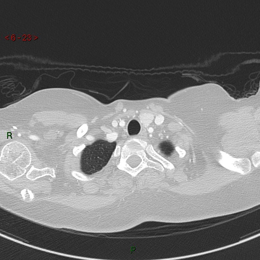 Aortic arch origin of left vertebral artery (Radiopaedia 51520-57286 Axial lung window 23).jpg