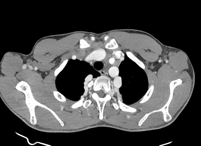 File:Aortic coarctation with aneurysm (Radiopaedia 74818-85828 A 166).jpg