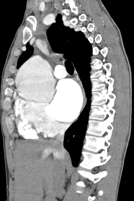 Aortic coarctation with aneurysm (Radiopaedia 74818-85828 B 72).jpg