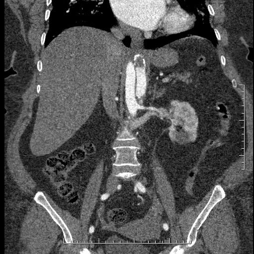 Aortic dissection- Stanford A (Radiopaedia 35729-37268 F 28).jpg