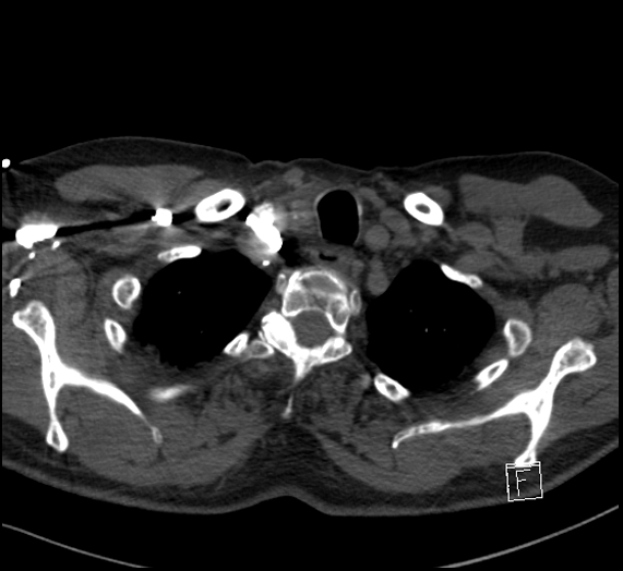 Aortic dissection (CTPA) (Radiopaedia 75506-86751 Axial C+ CTPA 15).jpg