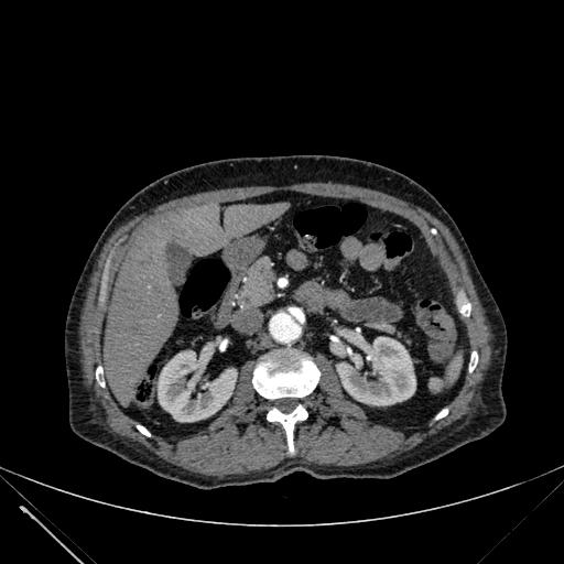 Aortic dissection (Radiopaedia 27466-27665 C+ arterial phase 342).jpg