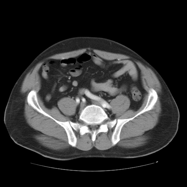 Aortic dissection (Radiopaedia 44411-48061 C 45).jpg