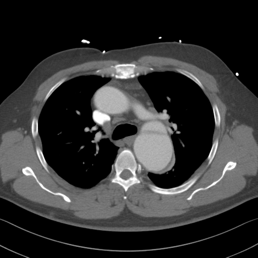 Aortic dissection (Radiopaedia 50763-56234 A 20).png