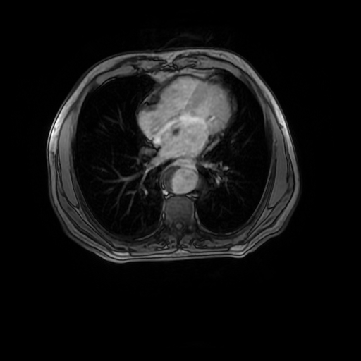 Aortic dissection - Stanford A - DeBakey I (Radiopaedia 23469-23551 Axial MRA 23).jpg