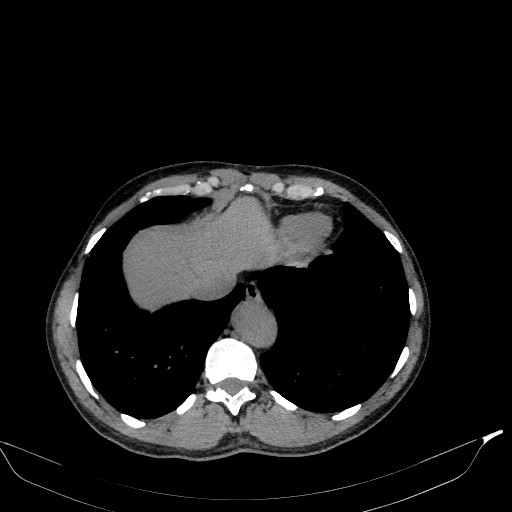 Aortic dissection - Stanford type A (Radiopaedia 83418-98500 Axial non-contrast 36).jpg
