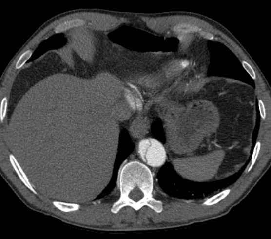 Aortic dissection - Stanford type B (Radiopaedia 73648-84437 A 96).jpg