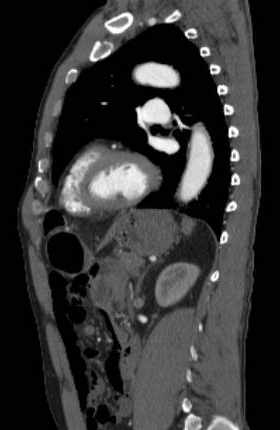 File:Aortic dissection - Stanford type B (Radiopaedia 73648-84437 C 55).jpg
