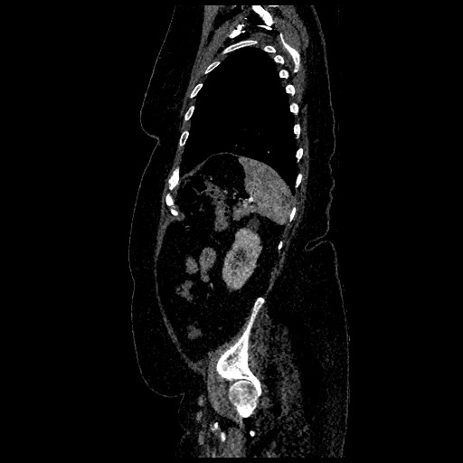 File:Aortic dissection - Stanford type B (Radiopaedia 88281-104910 C 72).jpg