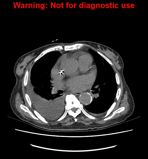 Aortic graft infection (Radiopaedia 44979-48907 Axial non-contrast 1).jpg