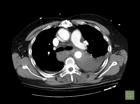 File:Aortic intramural hematoma (Radiopaedia 11198-11562 B 1).jpg
